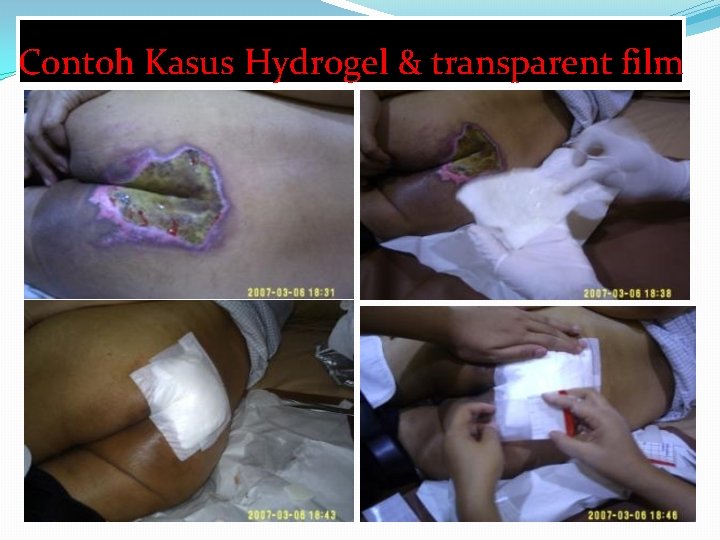 Contoh Kasus Hydrogel & transparent film 