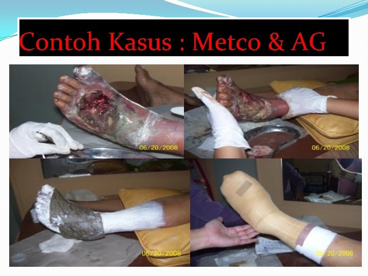 Contoh Kasus : Metco & AG 