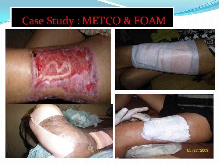 Case Study : METCO & FOAM 