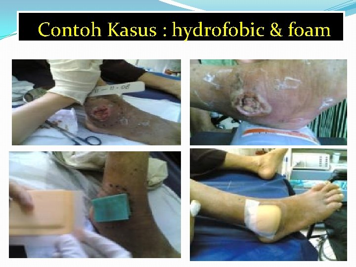 Contoh Kasus : hydrofobic & foam 