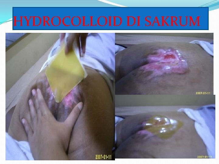 HYDROCOLLOID DI SAKRUM 