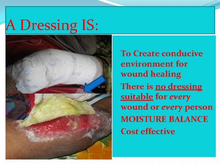 A Dressing IS: �To Create conducive environment for wound healing �There is no dressing