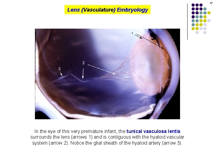 17 Lens (Vasculature) Embryology In the eye of this very premature infant, the tunical