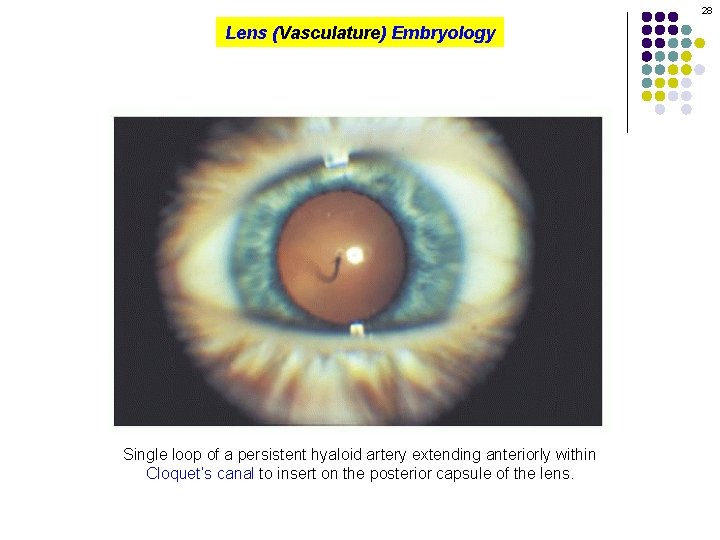 28 Lens (Vasculature) Embryology Single loop of a persistent hyaloid artery extending anteriorly within
