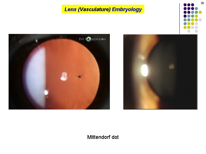 39 Lens (Vasculature) Embryology Mittendorf dot 