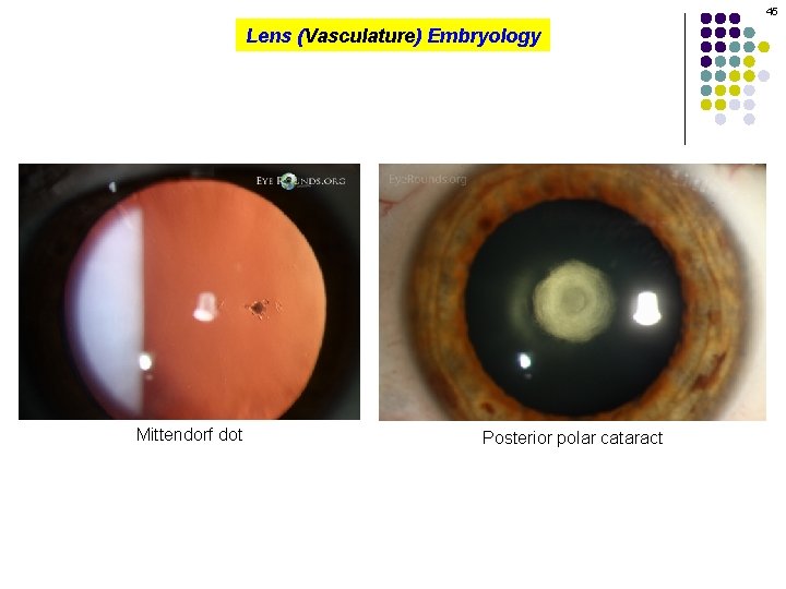 45 Lens (Vasculature) Embryology Mittendorf dot Posterior polar cataract 