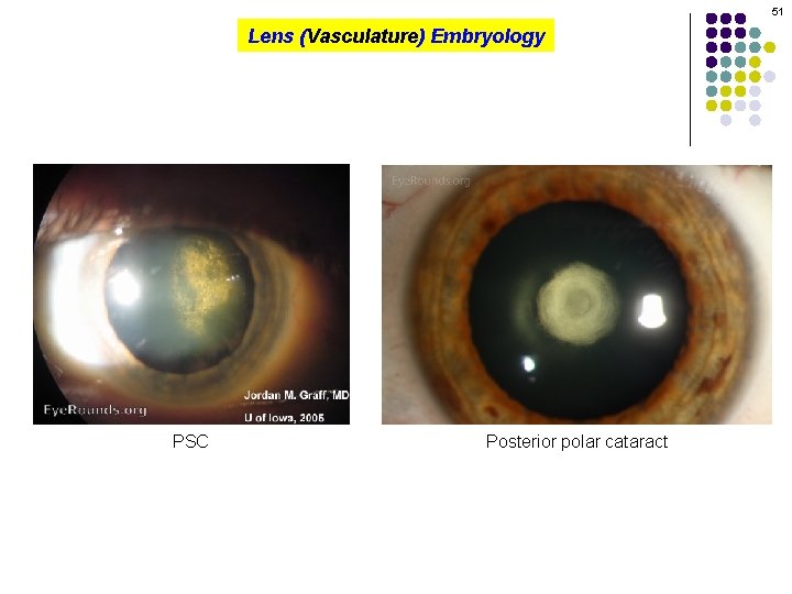 51 Lens (Vasculature) Embryology PSC Posterior polar cataract 