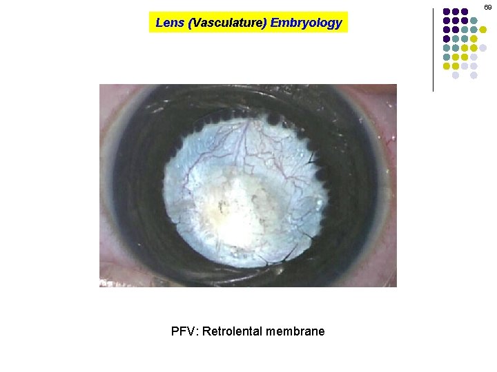 69 Lens (Vasculature) Embryology PFV: Retrolental membrane 