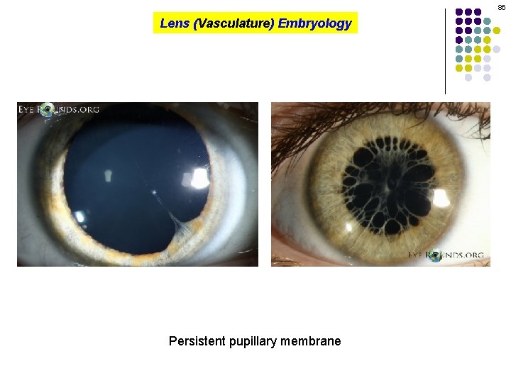 86 Lens (Vasculature) Embryology Persistent pupillary membrane 