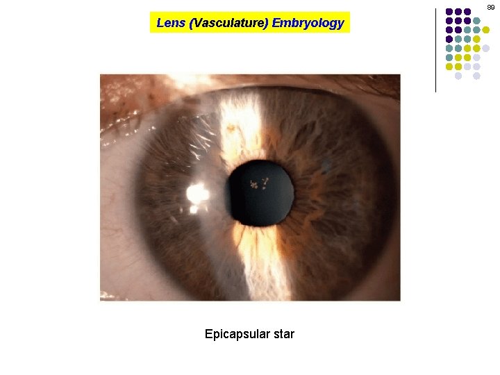 89 Lens (Vasculature) Embryology Epicapsular star 