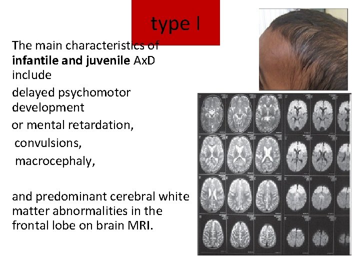 type I The main characteristics of infantile and juvenile Ax. D include delayed psychomotor