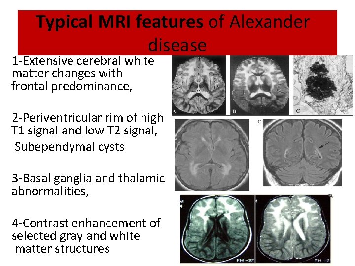 Typical MRI features of Alexander disease 1 -Extensive cerebral white matter changes with frontal