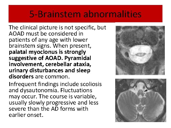 5 -Brainstem abnormalities The clinical picture is not specific, but AOAD must be considered