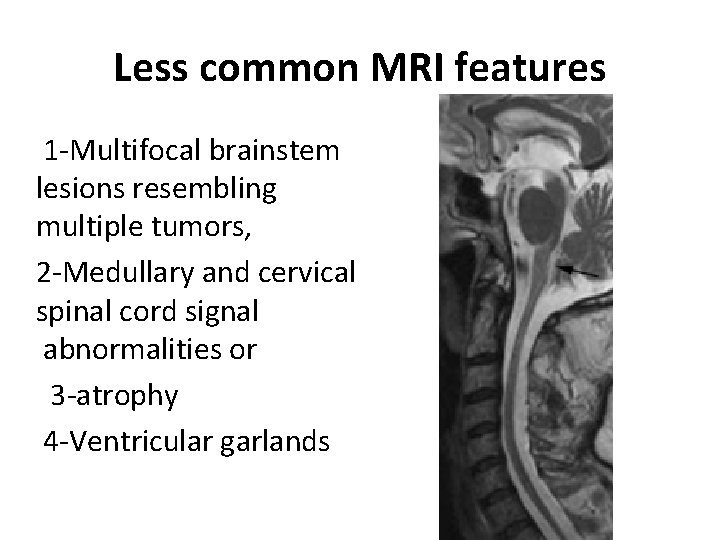 Less common MRI features 1 -Multifocal brainstem lesions resembling multiple tumors, 2 -Medullary and