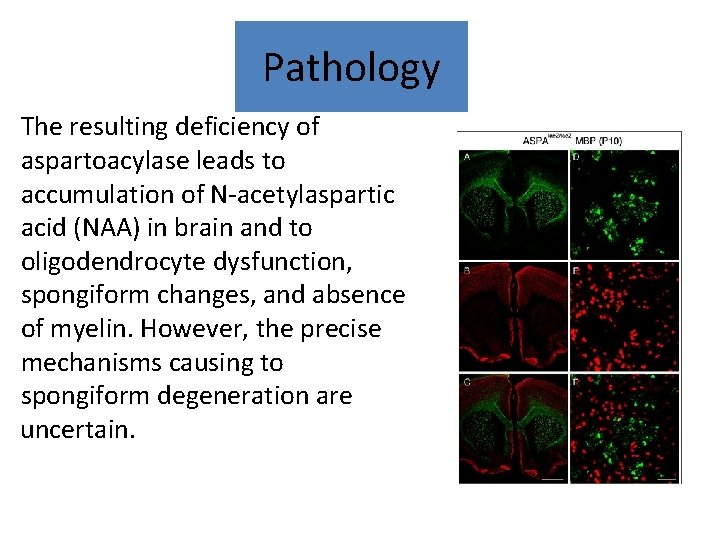Pathology The resulting deficiency of aspartoacylase leads to accumulation of N-acetylaspartic acid (NAA) in