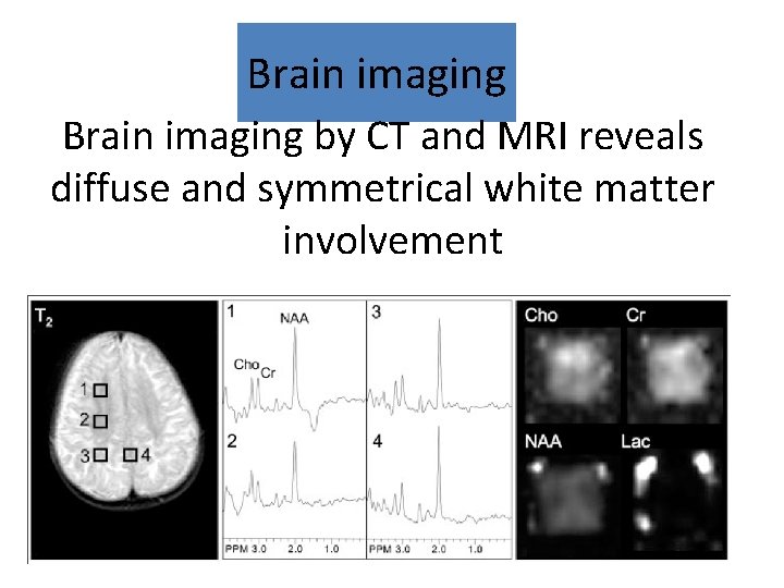 Brain imaging by CT and MRI reveals diffuse and symmetrical white matter involvement 