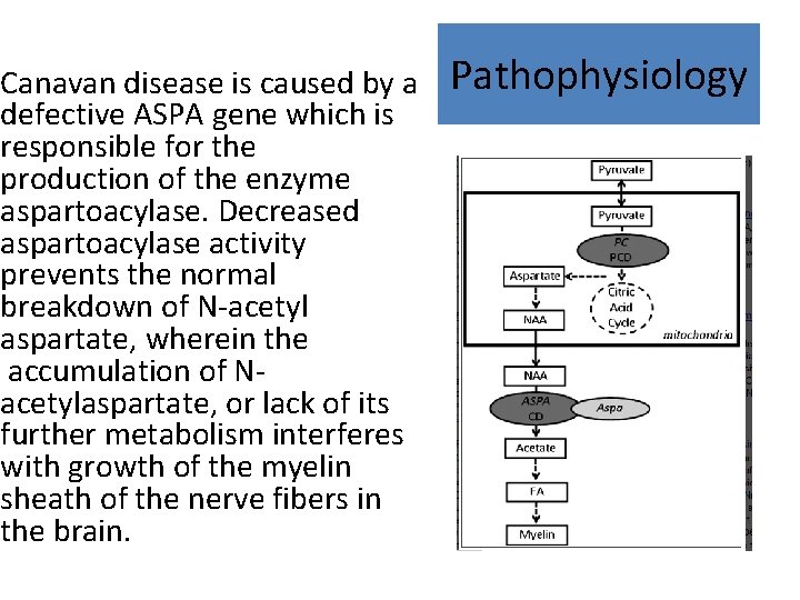 Canavan disease is caused by a defective ASPA gene which is responsible for the