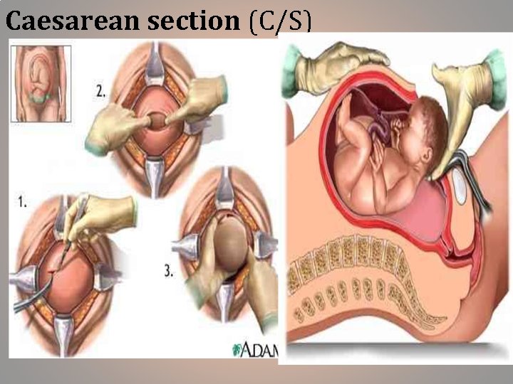 Caesarean section (C/S) 