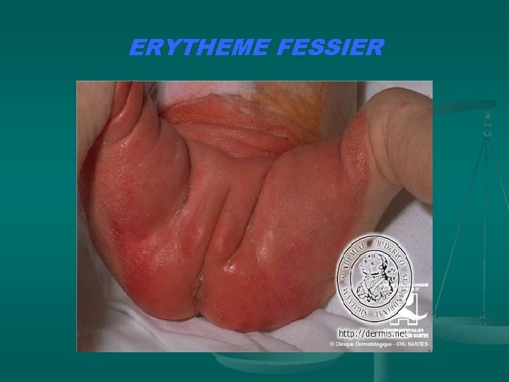 ERYTHEME FESSIER et n. ts w w w i p s. i 