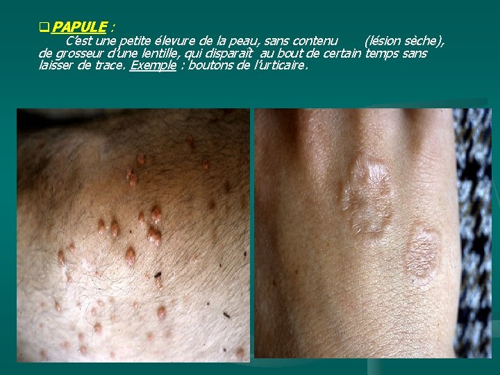 q. PAPULE : C’est une petite élevure de la peau, sans contenu (lésion sèche),