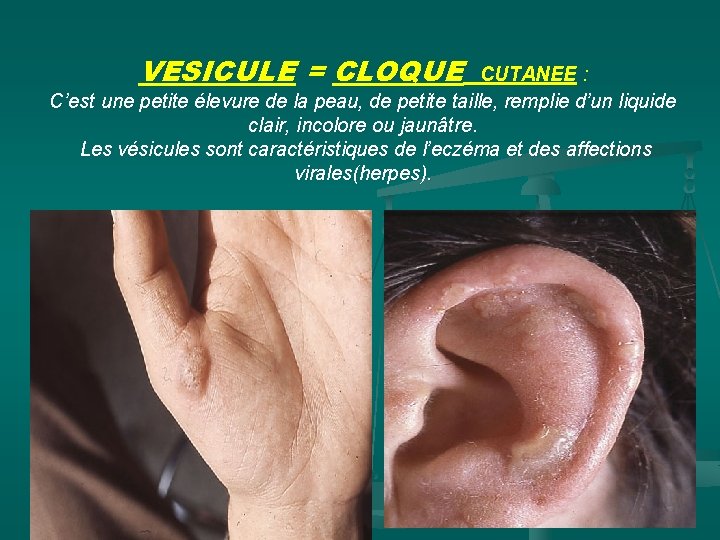 VESICULE = CLOQUE CUTANEE : C’est une petite élevure de la peau, de petite
