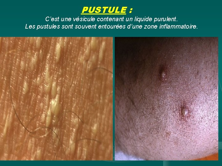 PUSTULE : C’est une vésicule contenant un liquide purulent. Les pustules sont souvent entourées