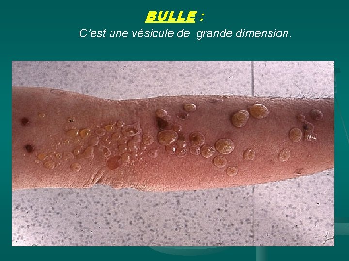 BULLE : C’est une vésicule de grande dimension. et n. ts w w w
