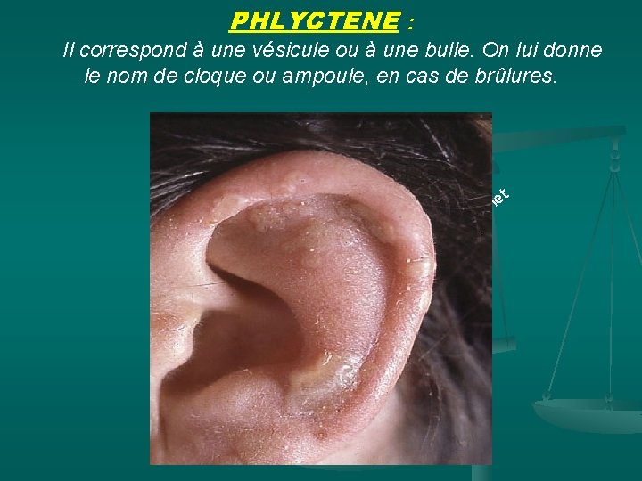 PHLYCTENE : Il correspond à une vésicule ou à une bulle. On lui donne