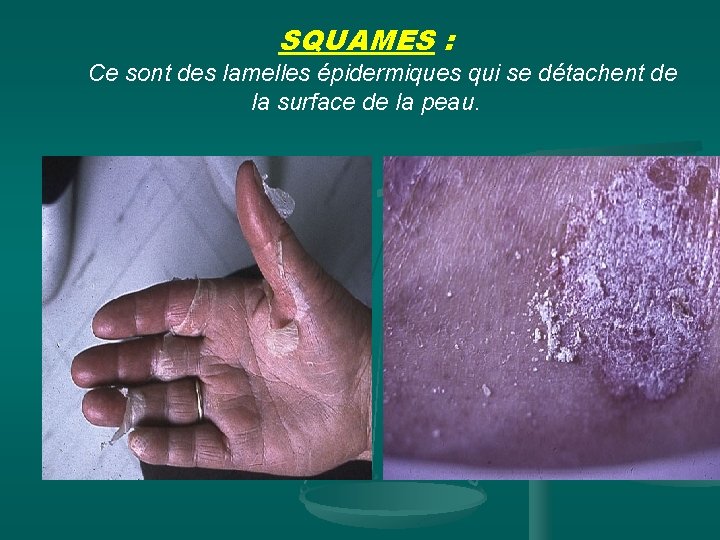 SQUAMES : Ce sont des lamelles épidermiques qui se détachent de la surface de