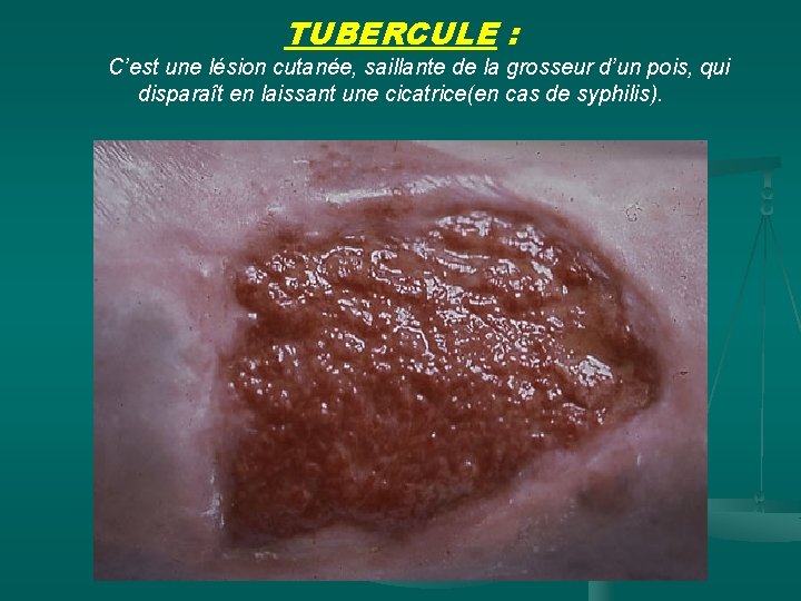 TUBERCULE : C’est une lésion cutanée, saillante de la grosseur d’un pois, qui disparaît