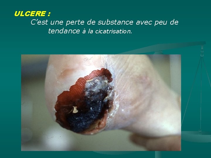 ULCERE : C’est une perte de substance avec peu de tendance à la cicatrisation.