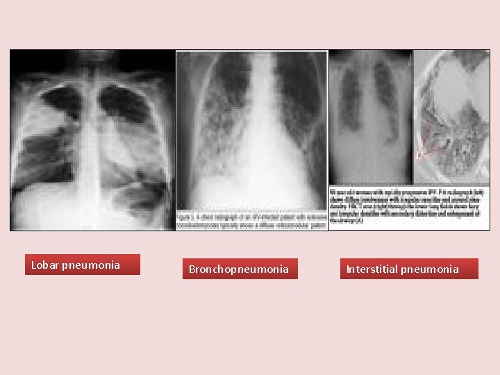 Lobar pneumonia Bronchopneumonia Interstitial pneumonia 