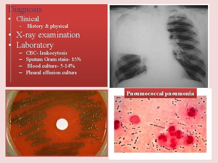 Diagnosis • Clinical – History & physical • X-ray examination • Laboratory – –