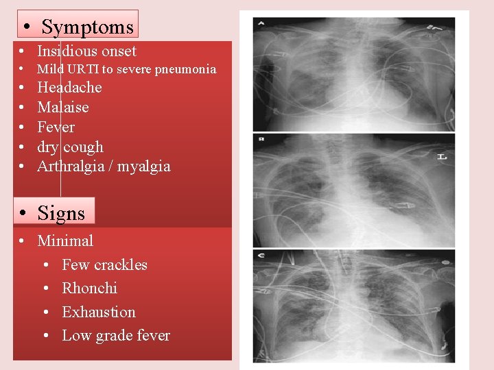  • Symptoms • Insidious onset • Mild URTI to severe pneumonia • •