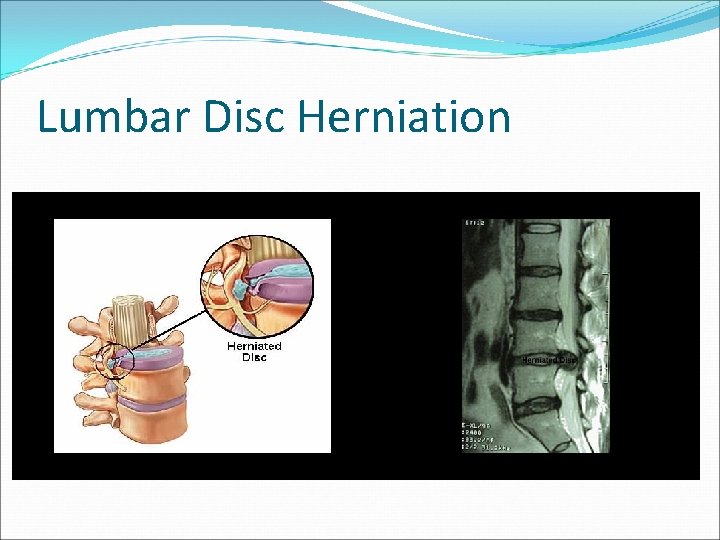 Lumbar Disc Herniation 