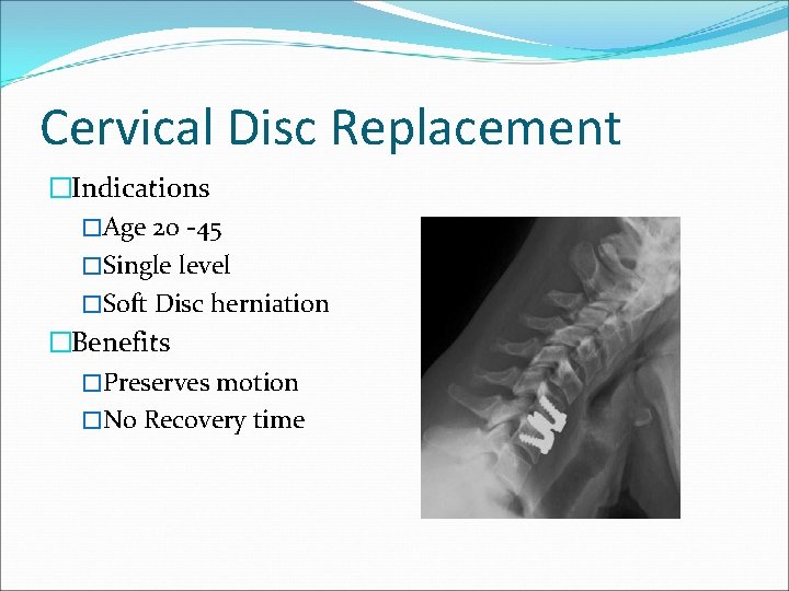 Cervical Disc Replacement �Indications �Age 20 -45 �Single level �Soft Disc herniation �Benefits �Preserves