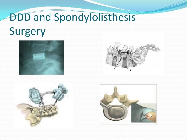 DDD and Spondylolisthesis Surgery 