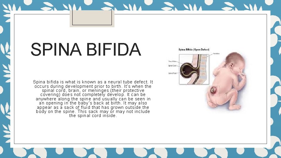 SPINA BIFIDA Spina bifida is what is known as a neural tube defect. It
