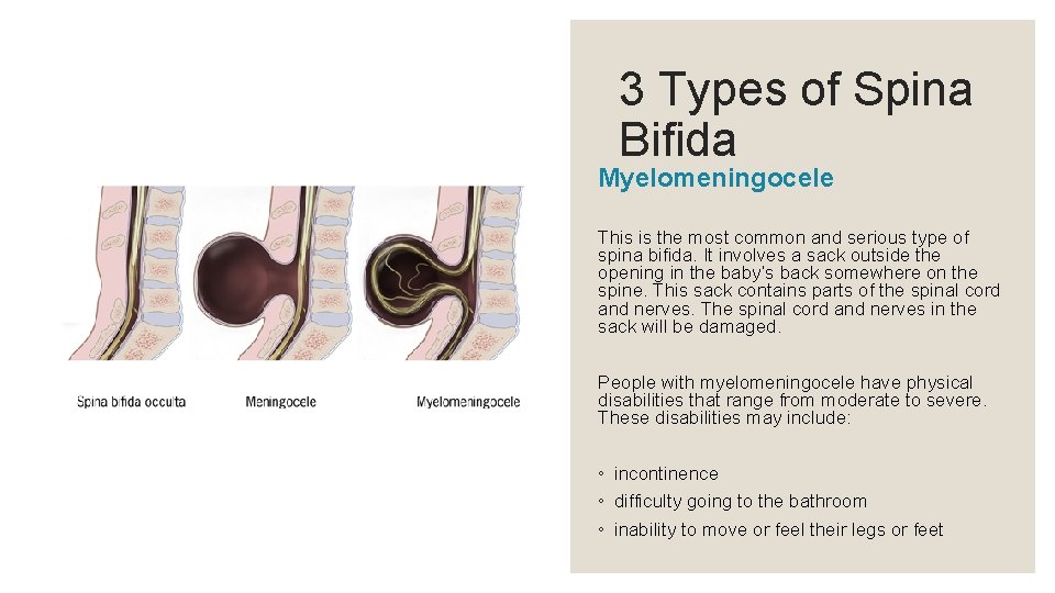 3 Types of Spina Bifida Myelomeningocele This is the most common and serious type
