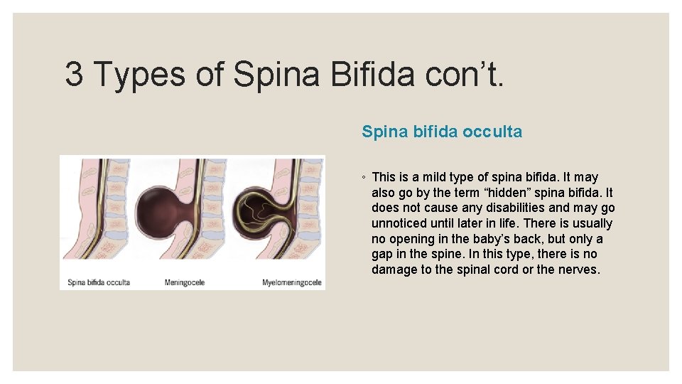 3 Types of Spina Bifida con’t. Spina bifida occulta ◦ This is a mild