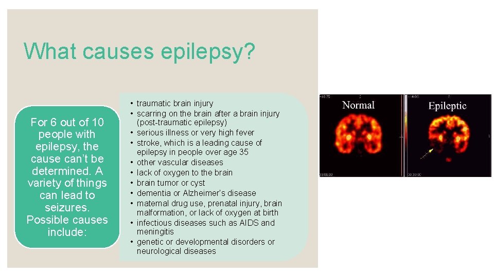 What causes epilepsy? For 6 out of 10 people with epilepsy, the cause can’t