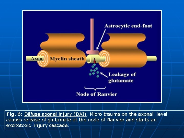 Fig. 6: Diffuse axonal injury (DAI). Micro trauma on the axonal level causes release