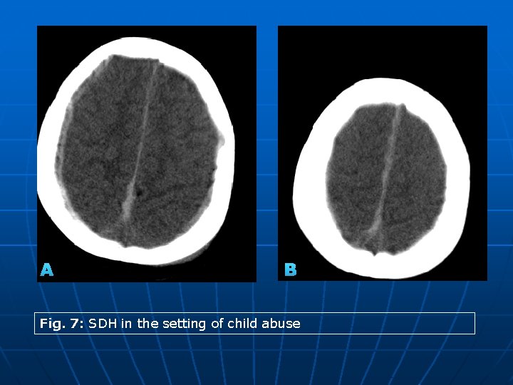 A B Fig. 7: SDH in the setting of child abuse 