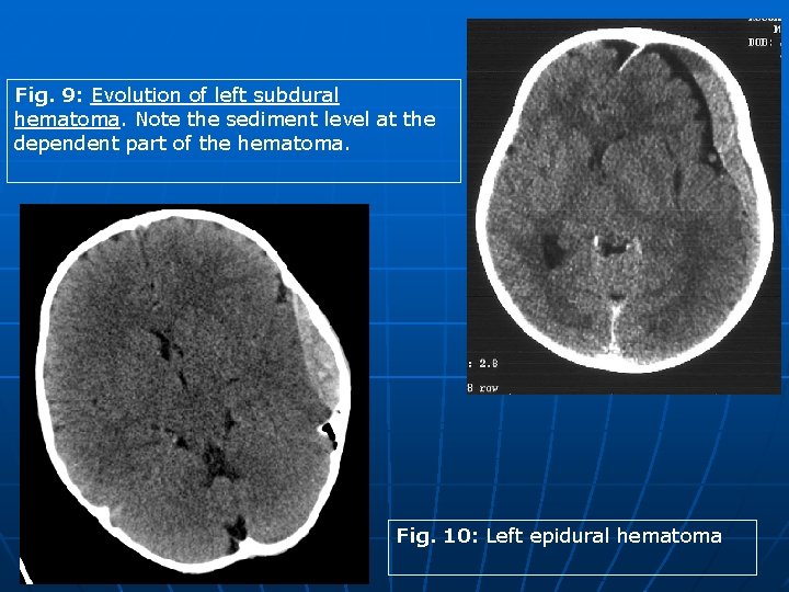 Fig. 9: Evolution of left subdural hematoma. Note the sediment level at the dependent