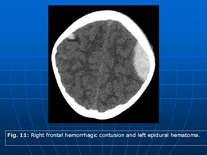 Fig. 11: Right frontal hemorrhagic contusion and left epidural hematoma. 