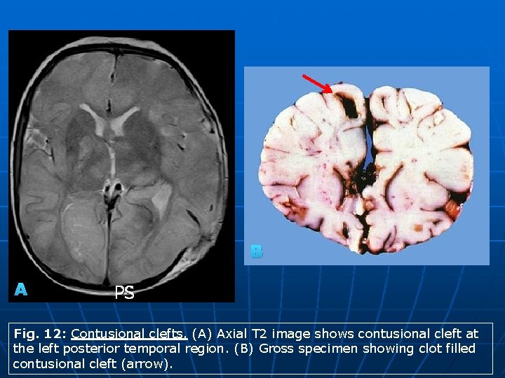 B A Fig. 12: Contusional clefts. (A) Axial T 2 image shows contusional cleft