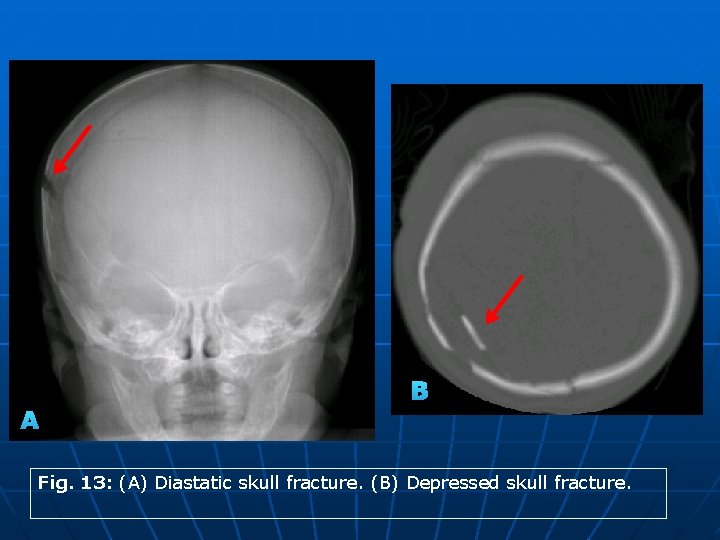 B A Fig. 13: (A) Diastatic skull fracture. (B) Depressed skull fracture. 