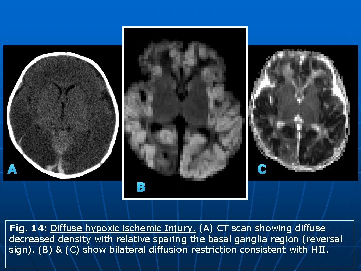 A C B Fig. 14: Diffuse hypoxic ischemic Injury. (A) CT scan showing diffuse