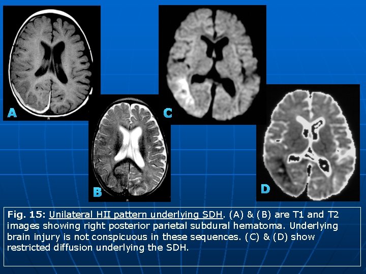 A C B D Fig. 15: Unilateral HII pattern underlying SDH. (A) & (B)