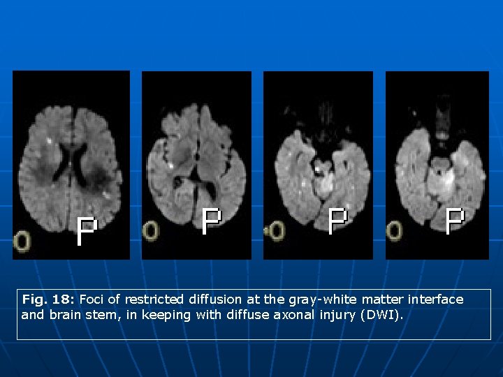 Fig. 18: Foci of restricted diffusion at the gray-white matter interface and brain stem,